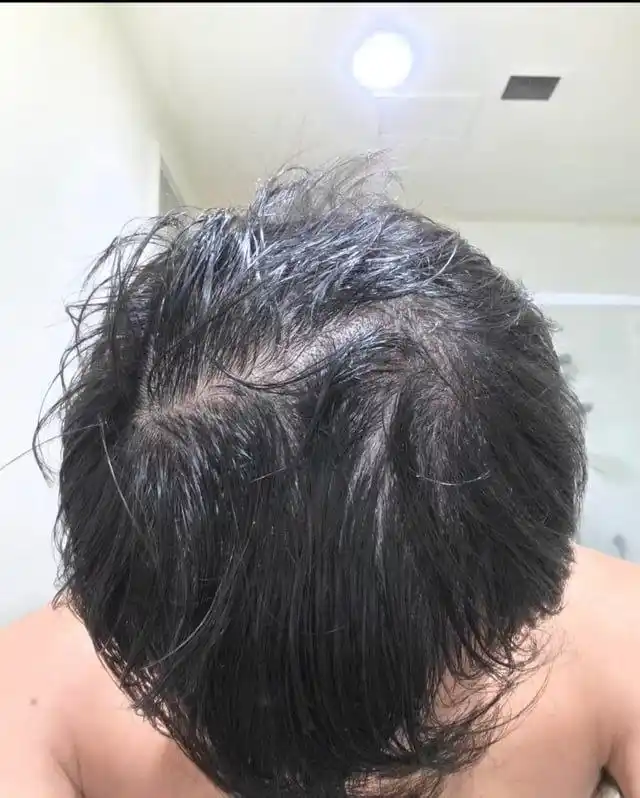 IiSolutions minoksidil 15% soch va soqol uchun, Minoxidil 15%
