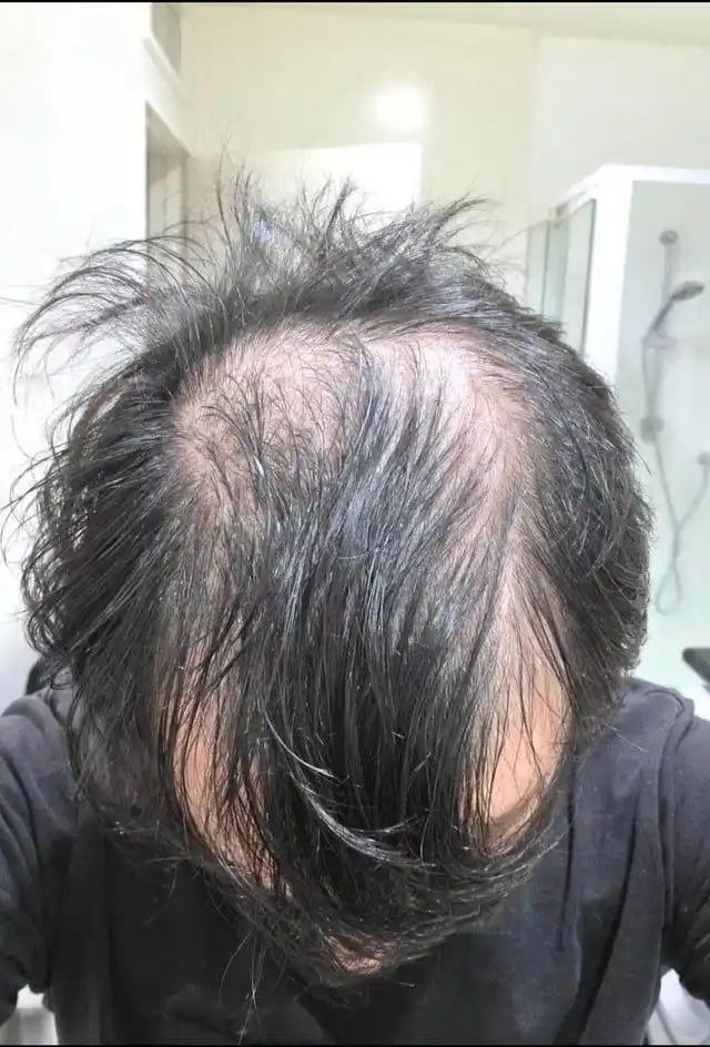 IiSolutions minoksidil 15% soch va soqol uchun, Minoxidil 15%