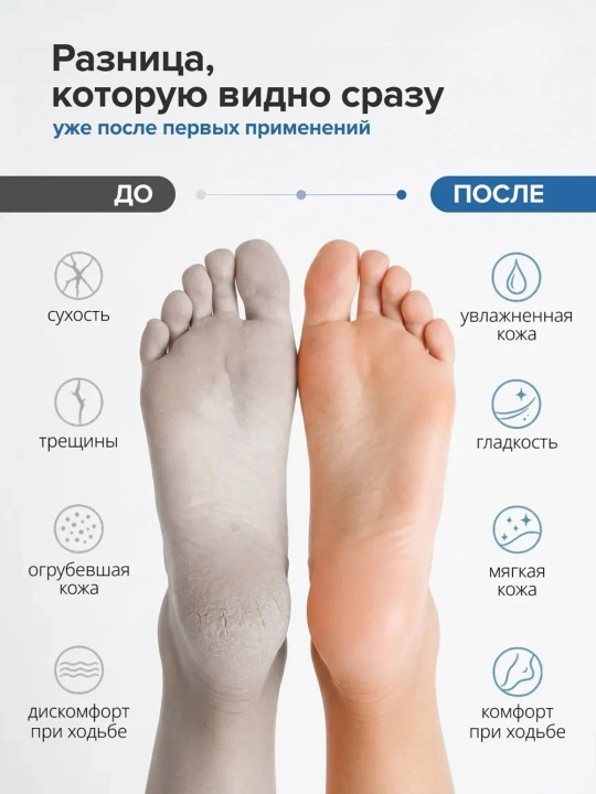 To‘piq yoriqlarini davolash uchun namlantiruvchi silikon paypoqlar va oyoq paypoqlari