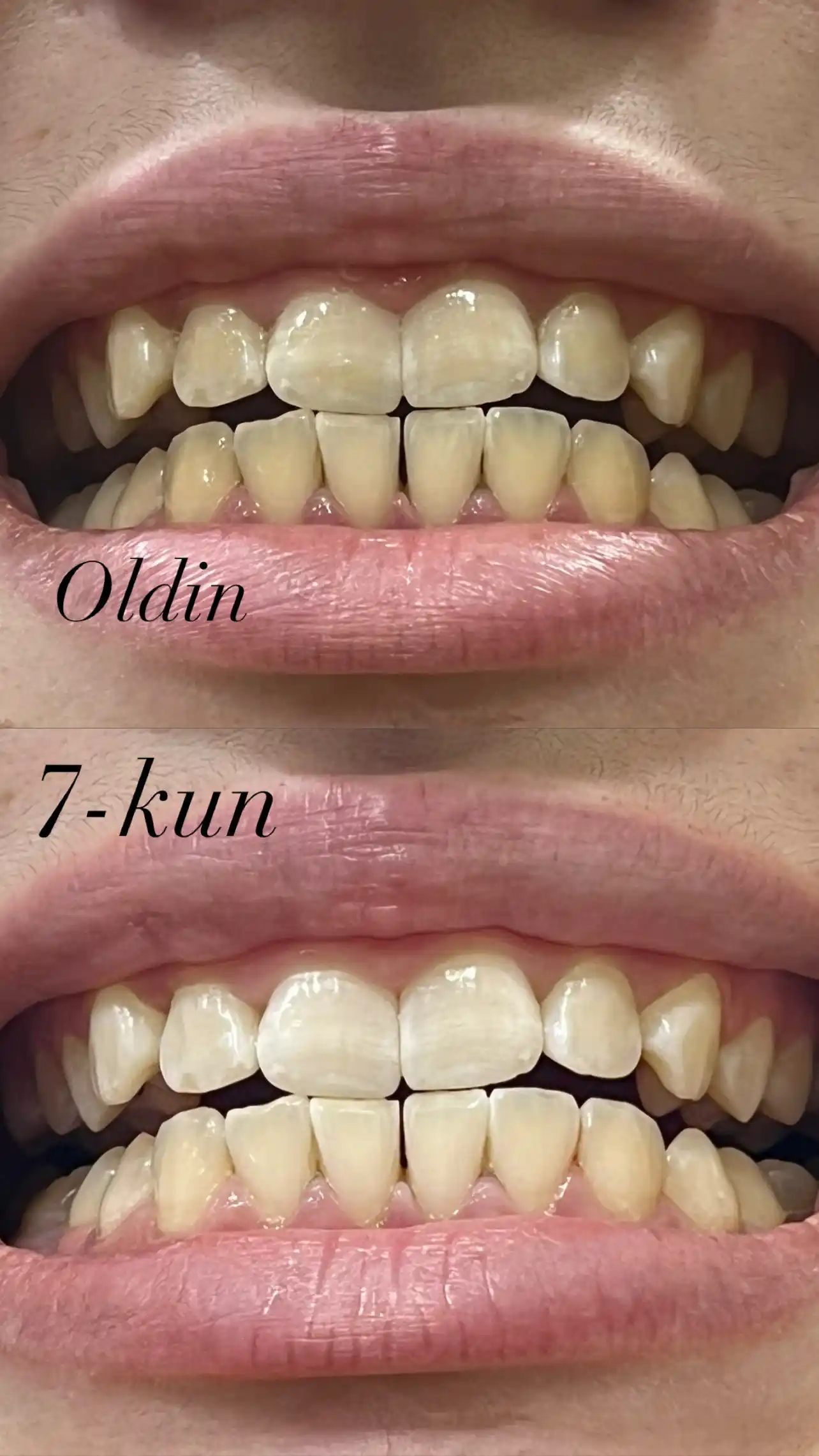 9D Ленты для отбеливания зубов, 7 пар лент в 1 коробке
