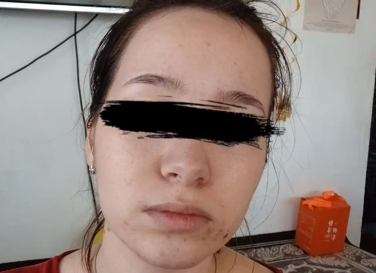 Yuz yuvish uchun sovun ugrilarni yo'qotadi yog'li yuzga yuz oqartirishga sovun