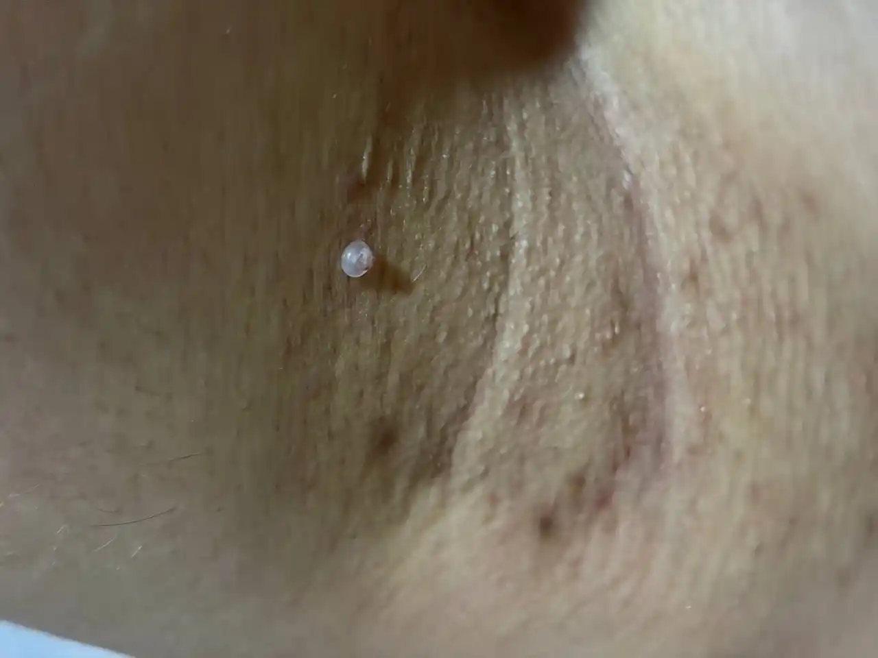 Papilloma va teri o‘simtalarini xavfsiz olib tashlash uchun to‘plam