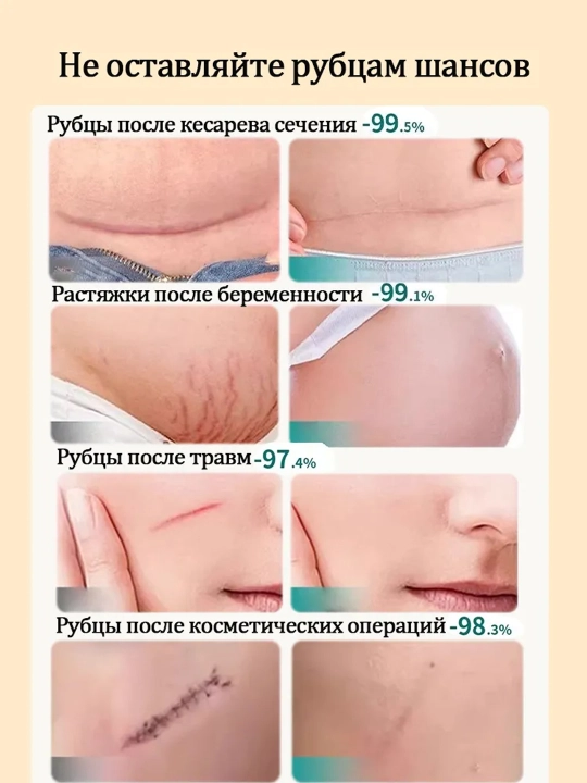 Крем от шрамов рубцов и растяжек для тела LYDIMOON мазь от следов акне и постакне
