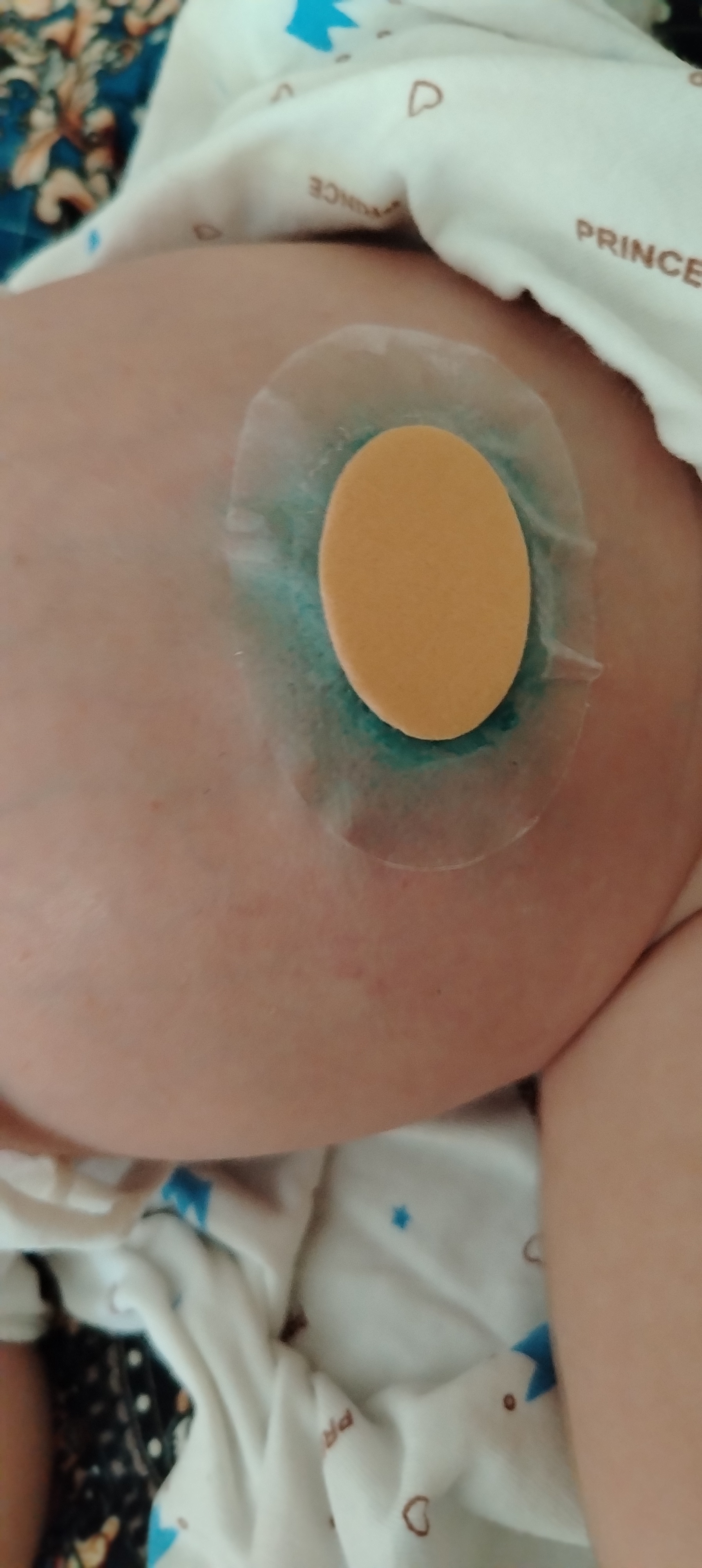 Gel asosida plastir, gidrokolloidli, teri uchun himoya