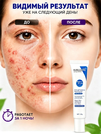 Гель от прыщей и акне IUALLURE, алоэ вера, точечный крем для проблемной кожи лица, 20 мл - 
