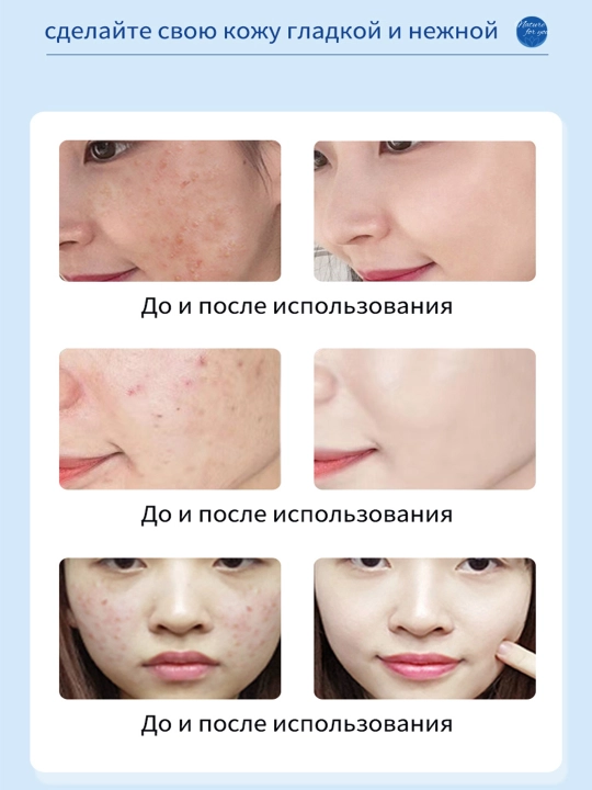 Гель от прыщей и акне IUALLURE, алоэ вера, точечный крем для проблемной кожи лица, 20 мл