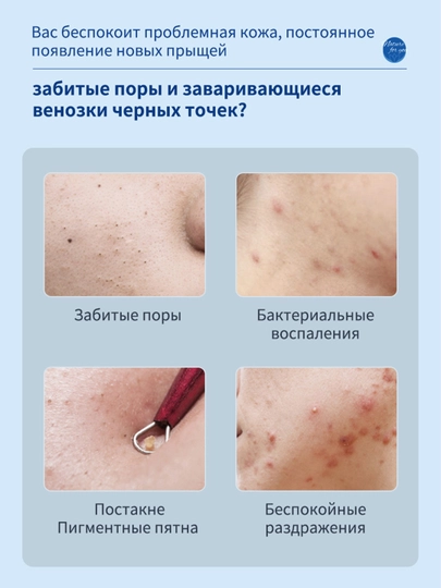 Гель от прыщей и акне IUALLURE, алоэ вера, точечный крем для проблемной кожи лица, 20 мл