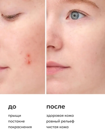Крем против угревой сыпи BIOAQUA с салициловой кислотой, 20 г