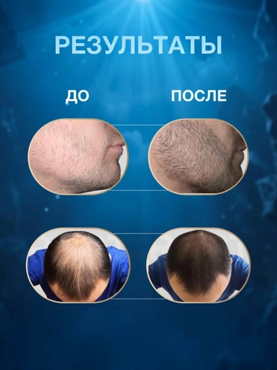 Kirkland Minoxidil 5%. Раствор для роста волос и бороды