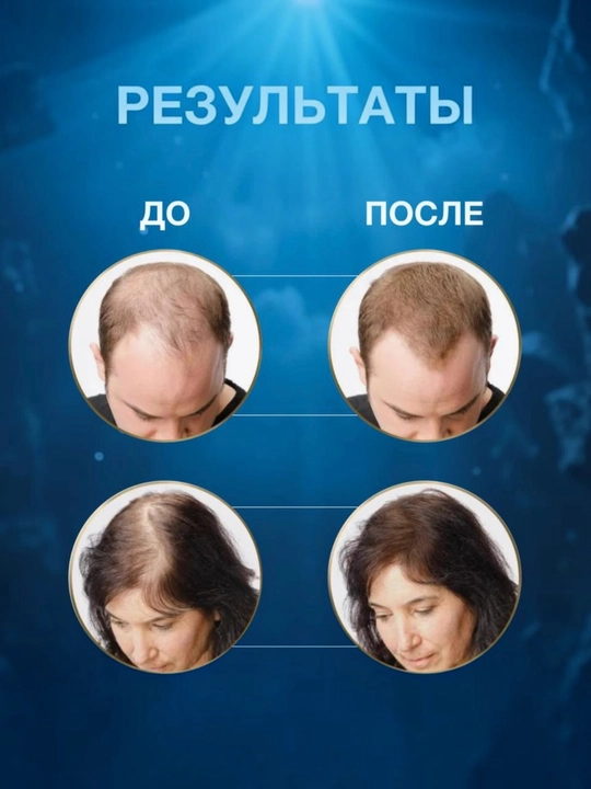 Kirkland Minoxidil 5%. Раствор для роста волос и бороды