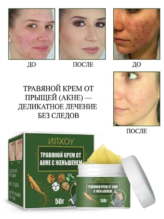 Akne, aknedan keyingi izlar va qizarishga qarshi tozalovchi o‘simlikli yuz kremi, 50 g