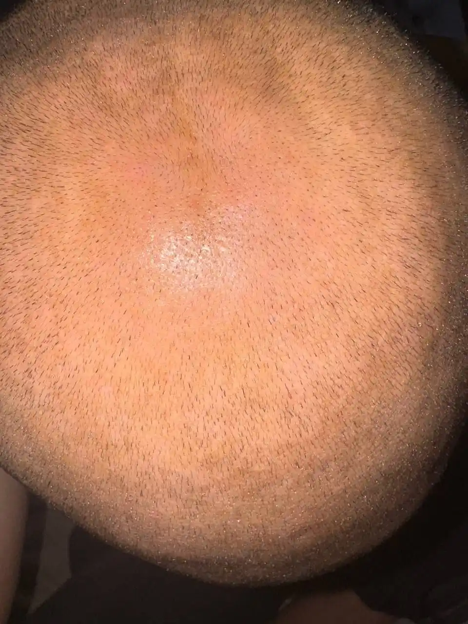 IiSolutions minoksidil 15% soch va soqol uchun, Minoxidil 15%