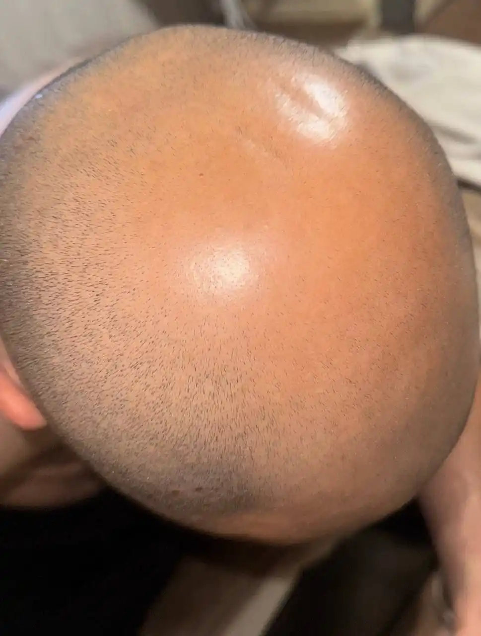 IiSolutions minoksidil 15% soch va soqol uchun, Minoxidil 15%