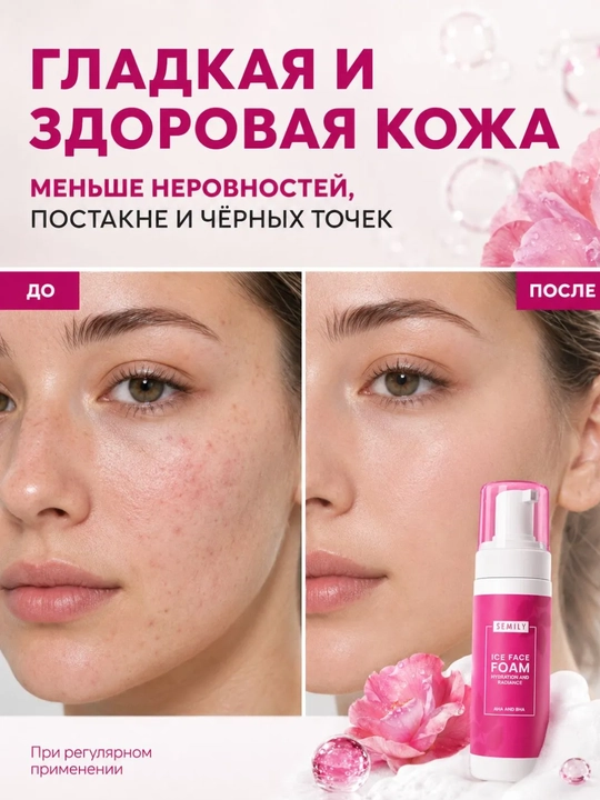Пенка для лица от прыщей и черных точек SEMILY, умывалка увлажняющая 150 мл