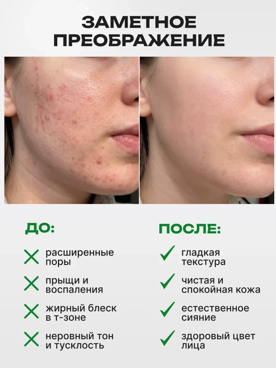Cыворотка для лица с азелаиновой кислотой Anua Azelaic Acid 10, против прыщей и акне