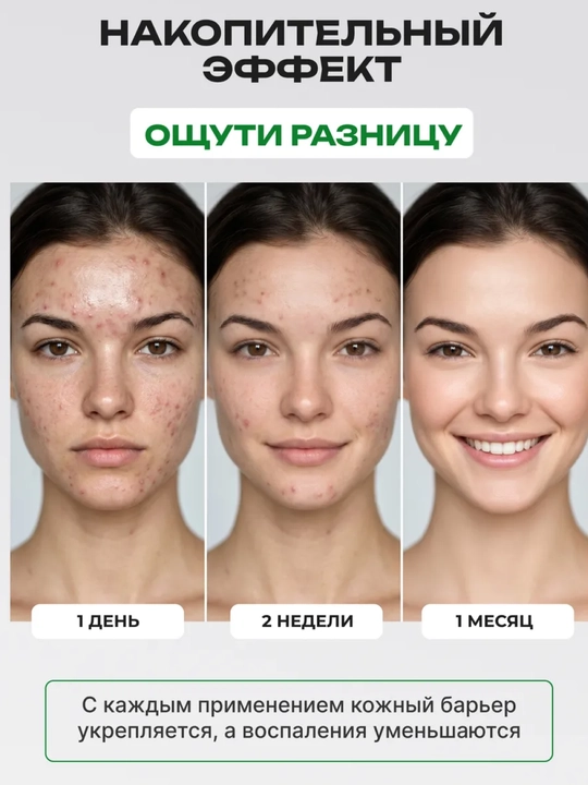 Cыворотка для лица с азелаиновой кислотой Anua Azelaic Acid 10, против прыщей и акне
