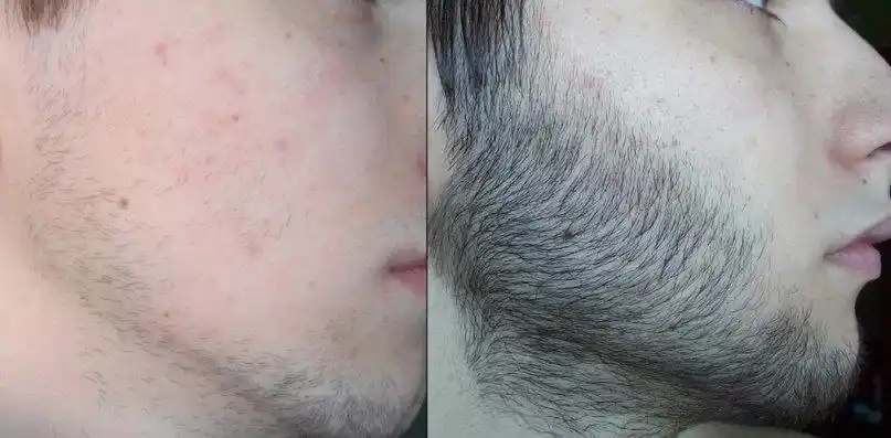 Набор Minoxidil 10% миноксидил для роста волос и бороды
