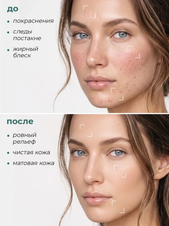 Крем-уход для жирной и проблемной кожи против акне Aravia, Acne-Balans Cream, 50 мл