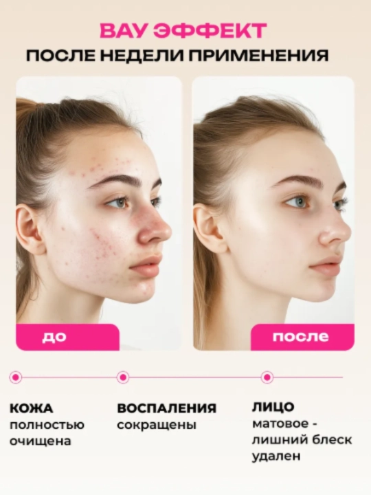 Гель для умывания лица, от прыщей, умывашка, гель умывалка, гель для лица с кислотами