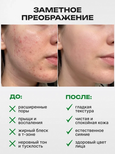 Крем от прыщей AYA, крем для лица, салициловая мазь, против прыщей, от черных точек