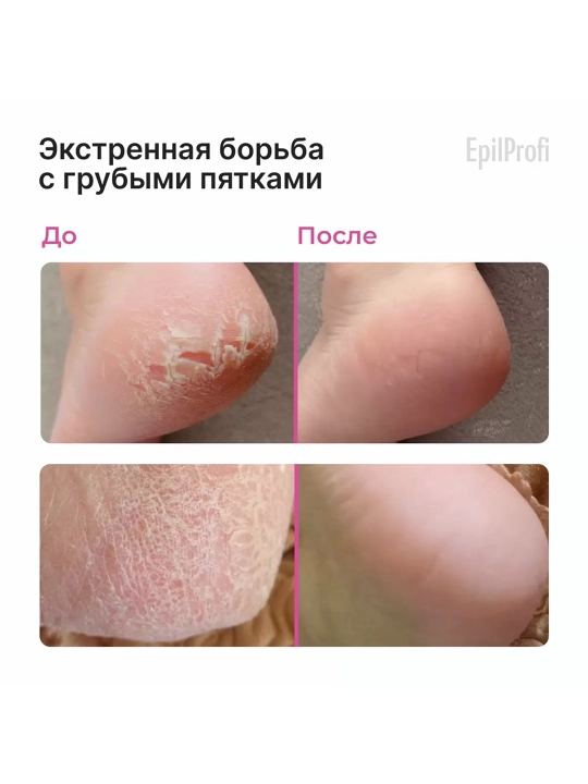 EPILPROFI Mochevina bilan pedikyur uchun gel, 400 ml