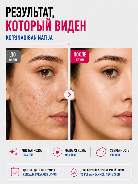 Сыворотка для лица от прыщей, постакне, комедонов, жирности, чёрных точек, пятен BeautyBox