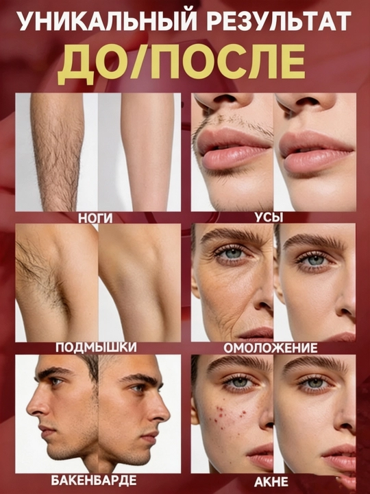 Fotoepilyator, lazerli, professional, sochlarni olib tashlash uchun