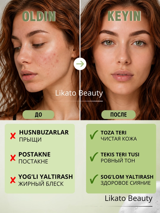 Yuzni yuvish uchun penka, yog'li teri va postakne uchun umivalka  Likato Post Acne, 150 ml