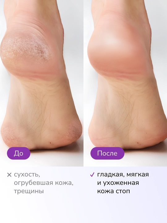 Крем для ног LABA Urea 20% со смягчающим эффектом, 150 мл