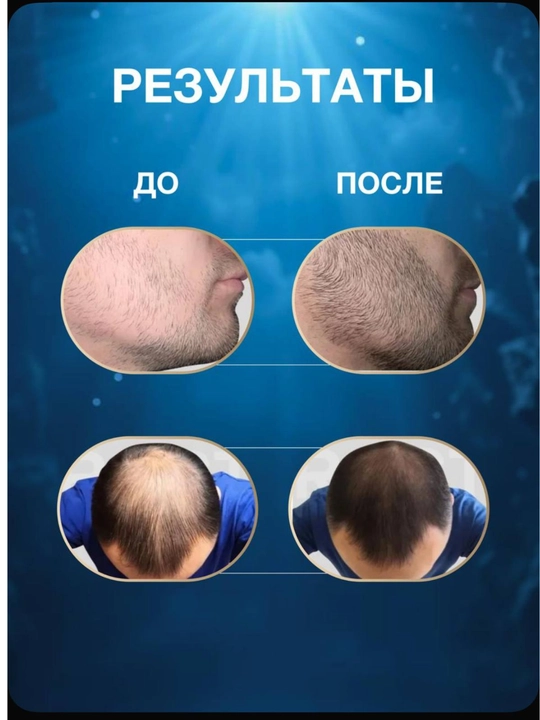 Миноксидин 5% Kirkland — эффективное средство от выпадения волос и для роста бороды, 60 мл