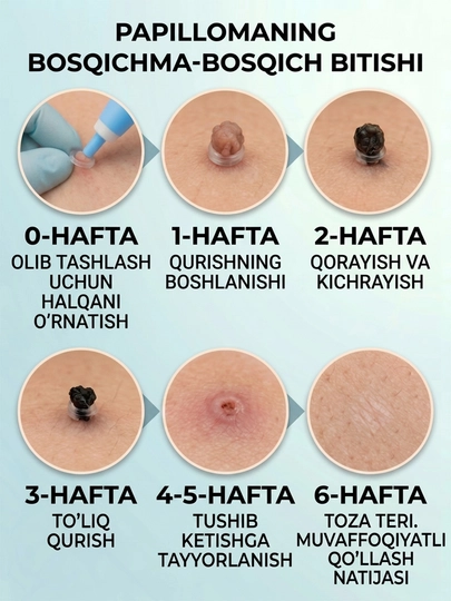 Papilloma va teri o‘simtalarini xavfsiz olib tashlash uchun to‘plam