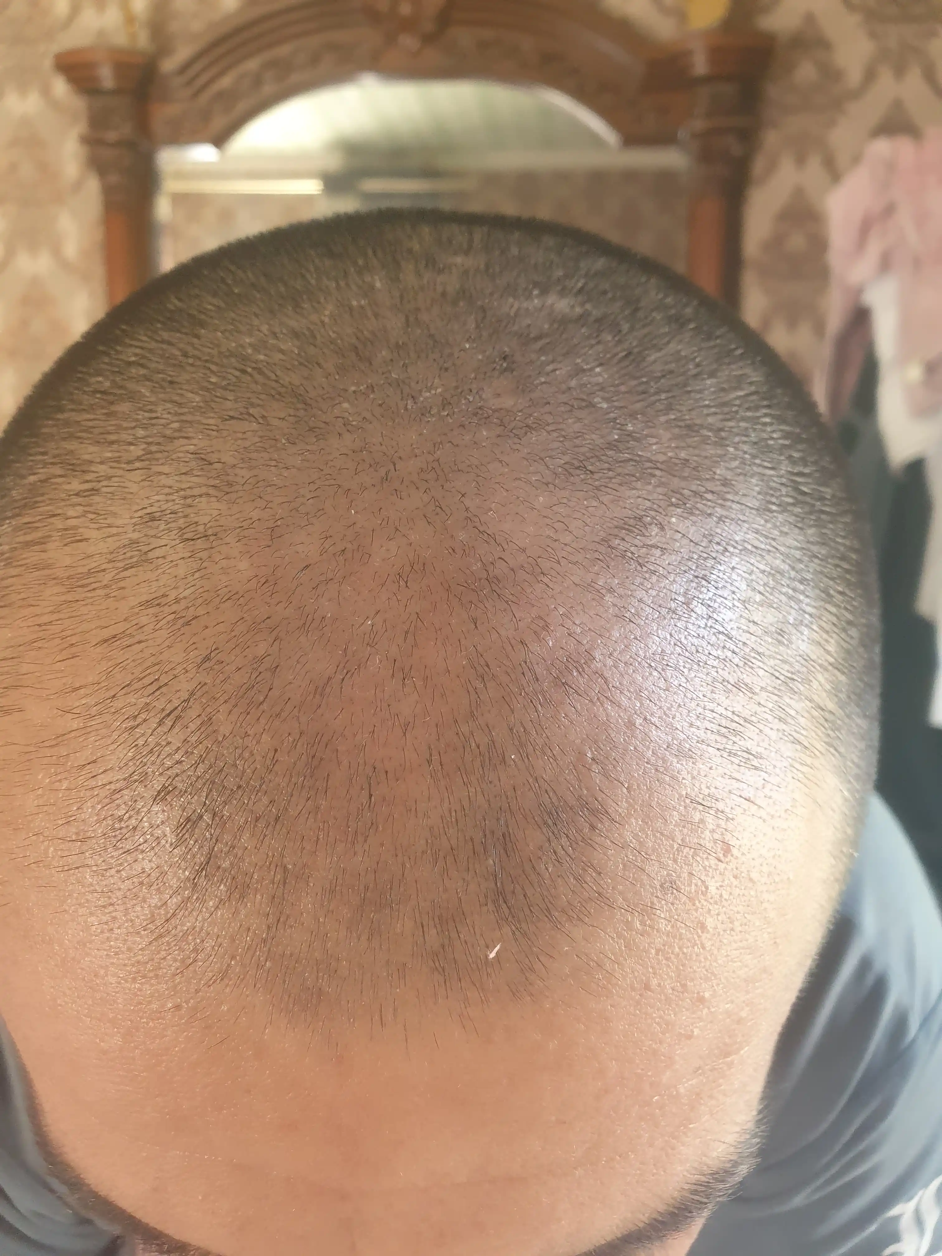 Soch va soqol o'stirish uchun minoksidil Kirkland Minoxidil 5%, 60 ml
