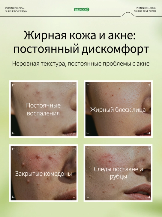 Крем для лица от прыщей и чёрных точек, коллоидная сера и азелаиновая кислота, 30 г