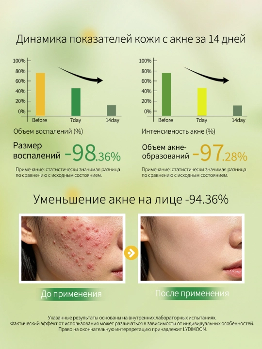 Крем для лица от прыщей и чёрных точек, коллоидная сера и азелаиновая кислота, 30 г