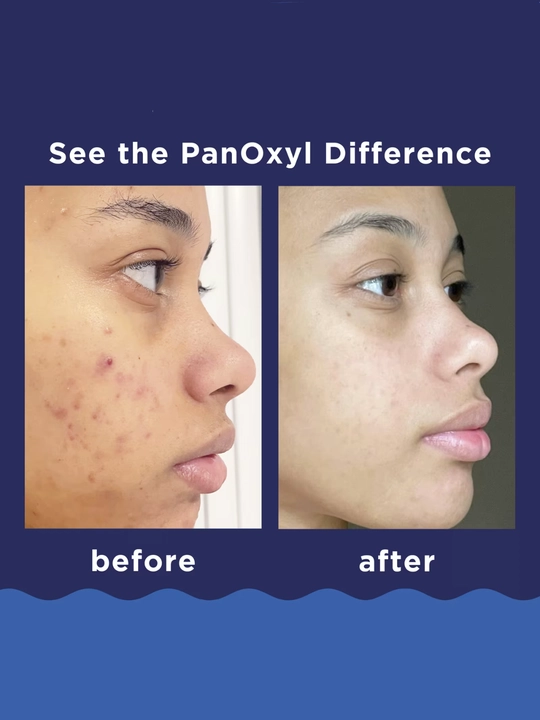 PanOxyl Acne Foaming Wash 10% — пенка для умывания и очищения кожи