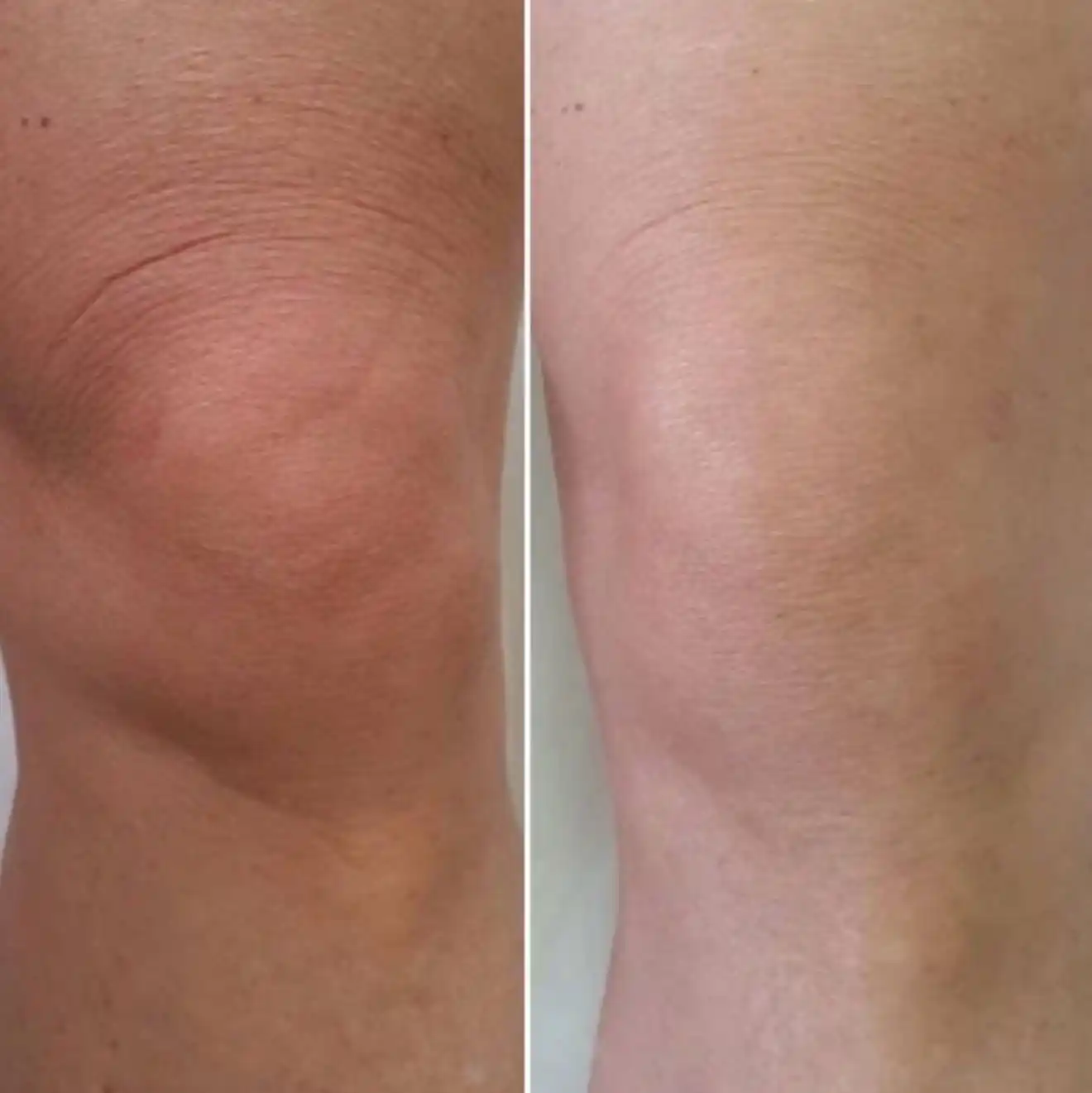 BEAUTÉ Melasma-X 3D oqartiruvchi krem qo‘ltiq, tirsak va bikini sohalari uchun