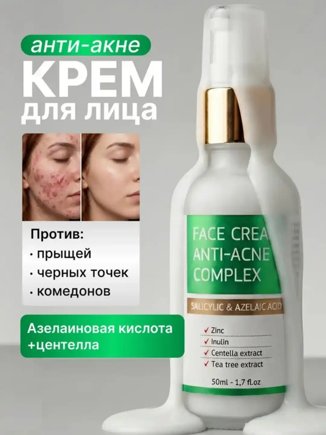 Крем от прыщей AYA, крем для лица, салициловая мазь, против прыщей, от черных точек