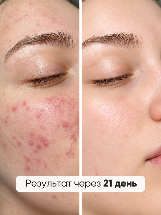 Anua Azelaic Acid 10 + Hyaluron yuz uchun 10% li zardob