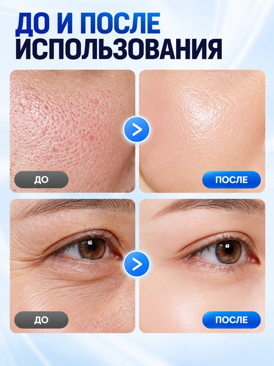 Suvli,nano-mezodermal yuz essensiyasi bilan o'z-o'zidan teri ostiga igna kiritish vositasi