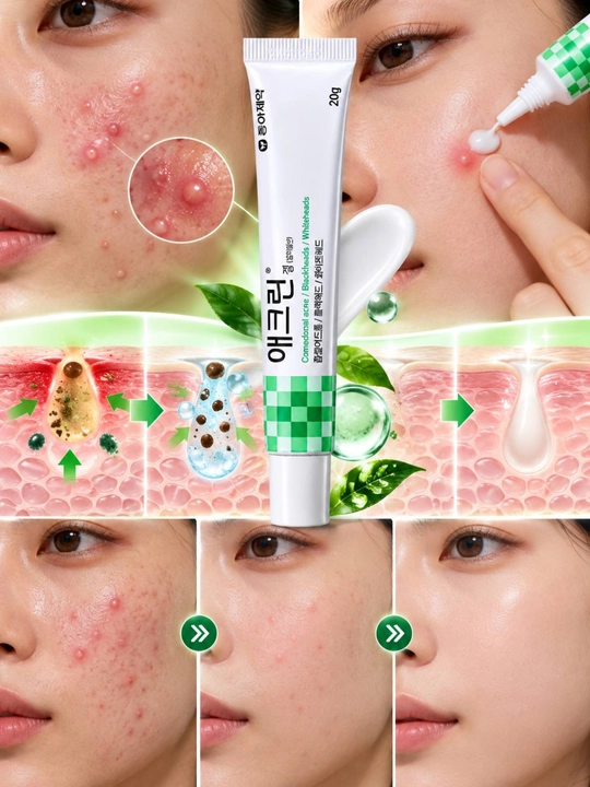 Aclean — гель против акне и воспалений, кремы от прыщей и угревой сыпи
