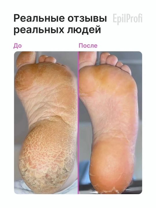 EPILPROFI Гель для педикюра с мочевиной, 400 мл