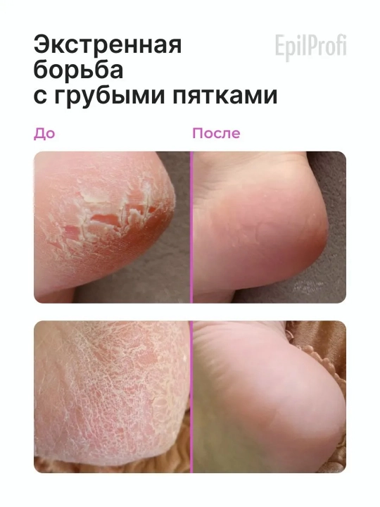 EPILPROFI Гель для педикюра с мочевиной, 400 мл